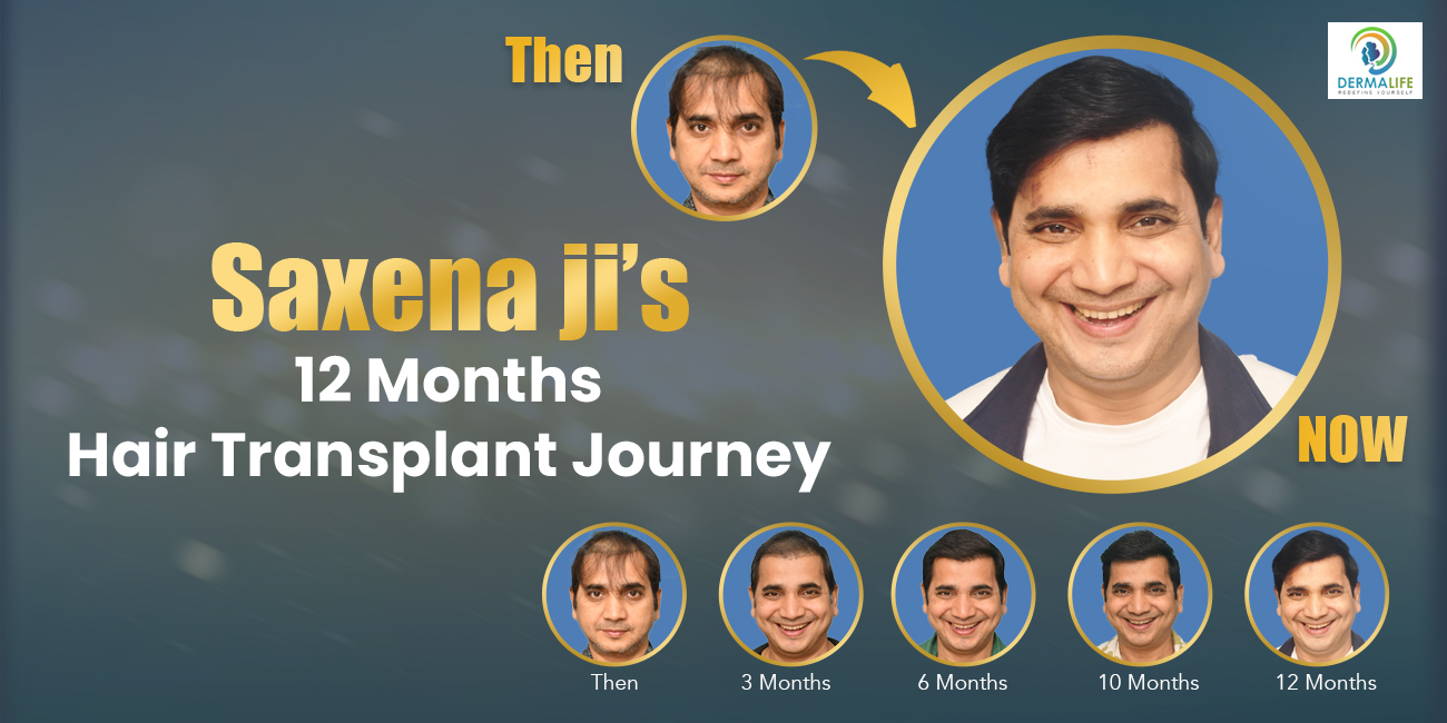 Why Hair Transplants Are the #1 Solution for Permanent Hair Loss